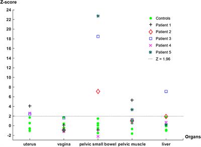 Sigma-1 Receptor Changes Observed in Chronic Pelvic Pain Patients: A Pilot PET/MRI Study